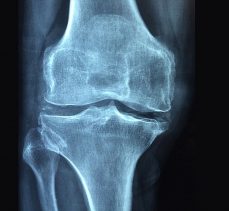 Osteoporoz 3 kadından birini kıskacına alıyor