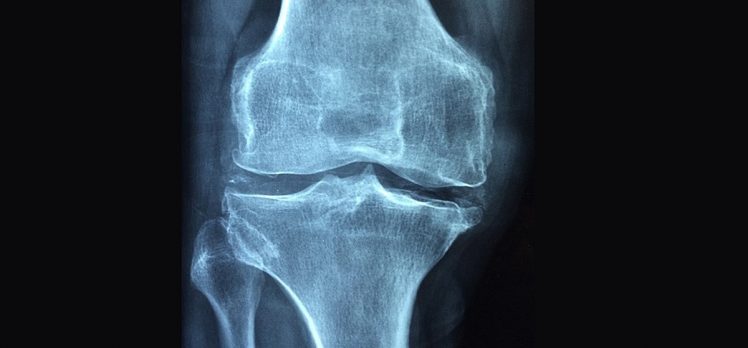 Osteoporoz 3 kadından birini kıskacına alıyor